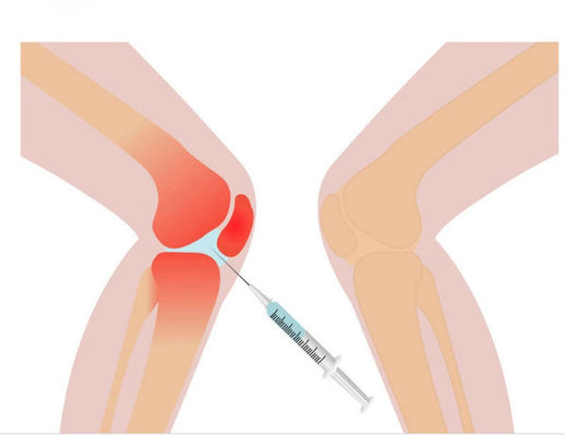 3ml Kniepijn Mesotherapie-oplossing Niet-verknoopt hyaluronzuur