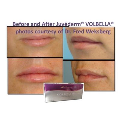 Hyaluronzuur Juvederm Gezichtsfiller Gel gladde en vlekkeloze huid