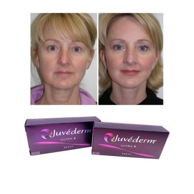 6-9 maanden Duur Juvederm Dermal Filler Gel online en in de winkel