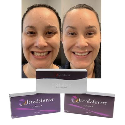 Juvederm Dermale Lip Fillers Hyaluronzuur Cross Linked Injection