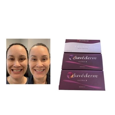 Cross-linked HA Juvederm Huiddermvuller Ultra3 Ultra4 Voluma Opslagcondities Vermijd Bevriezing Injecteerbare Gel voor Gezichtsvolumeherstel