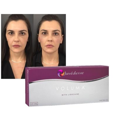 Hyaluronzuur dermale vullergel Juvederm Lippen Wangen Verjongingsverbeteringsformule