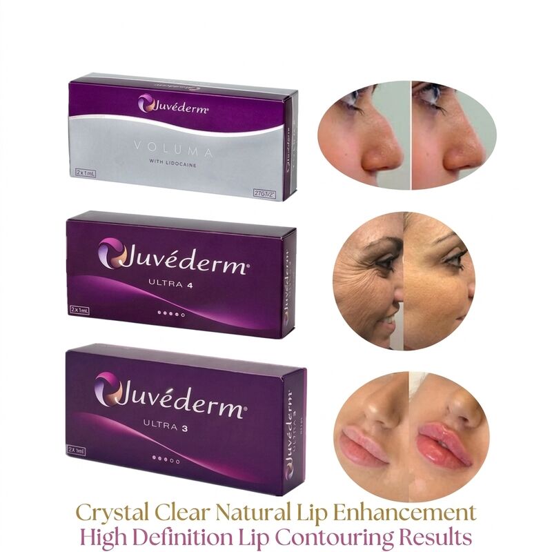 Volume van de spuit 2 1 ml per doos Juvederm Voluma Filler Veiligheid Gezichtscontouren Injecteerbare huidfiller voor volumevergroting
